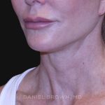 Neck Restoration Before & After Patient #10498