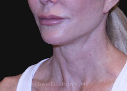 Neck Restoration Before & After Patient #10498