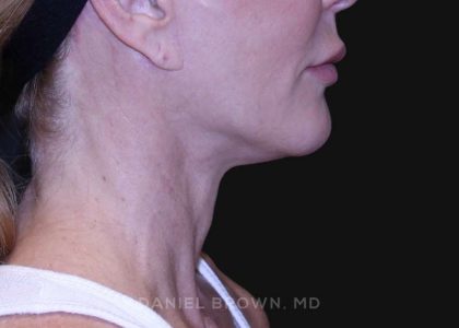 Neck Restoration Before & After Patient #10498