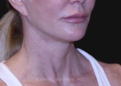 Neck Restoration Before & After Patient #10498