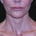 Neck Restoration Before & After Patient #10498