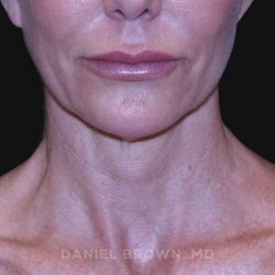 Neck Restoration Before & After Patient #10498