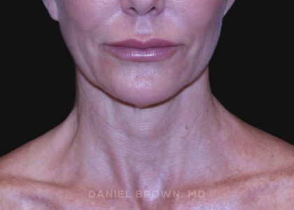 Neck Restoration Before & After Patient #10498