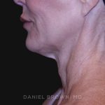 Neck Restoration Before & After Patient #10498