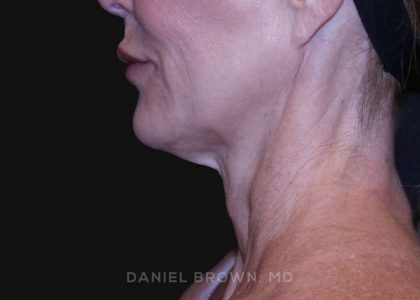 Neck Restoration Before & After Patient #10498