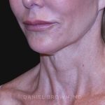 Neck Restoration Before & After Patient #10498