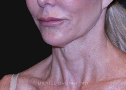 Neck Restoration Before & After Patient #10498