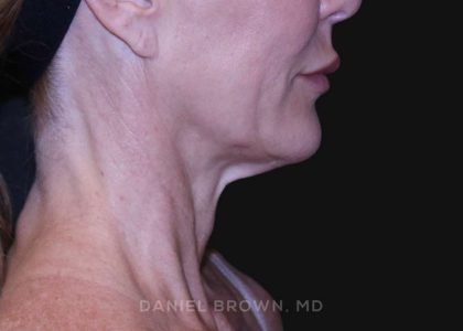 Neck Restoration Before & After Patient #10498
