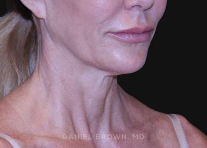 Neck Restoration Before & After Patient #10498