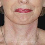 Neck Restoration Before & After Patient #10509