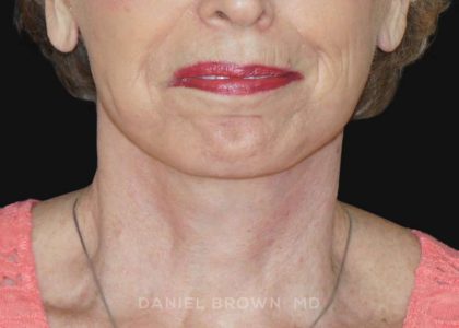 Neck Restoration Before & After Patient #10509