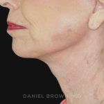 Neck Restoration Before & After Patient #10509
