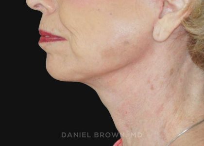 Neck Restoration Before & After Patient #10509