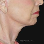 Neck Restoration Before & After Patient #10509