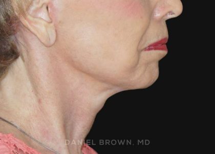 Neck Restoration Before & After Patient #10509
