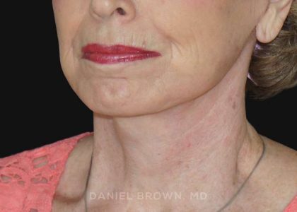 Neck Restoration Before & After Patient #10509