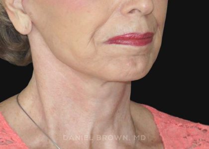 Neck Restoration Before & After Patient #10509