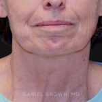 Neck Restoration Before & After Patient #10509
