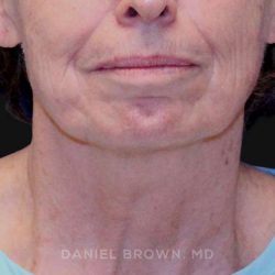Neck Restoration Before & After Patient #10509