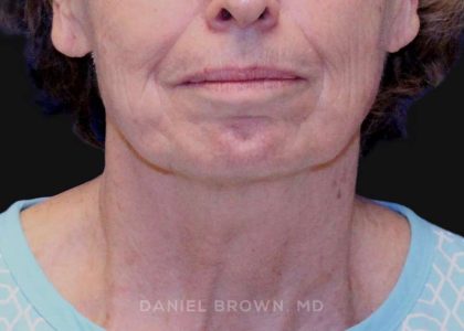 Neck Restoration Before & After Patient #10509