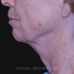 Neck Restoration Before & After Patient #10509