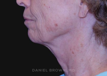 Neck Restoration Before & After Patient #10509