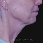 Neck Restoration Before & After Patient #10509