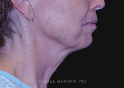 Neck Restoration Before & After Patient #10509