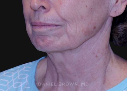 Neck Restoration Before & After Patient #10509