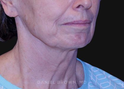 Neck Restoration Before & After Patient #10509