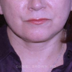 Neck Restoration Before & After Patient #10520