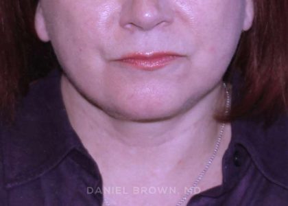 Neck Restoration Before & After Patient #10520