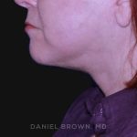 Neck Restoration Before & After Patient #10520