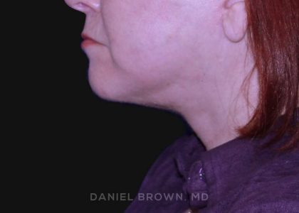 Neck Restoration Before & After Patient #10520