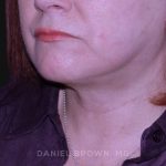 Neck Restoration Before & After Patient #10520
