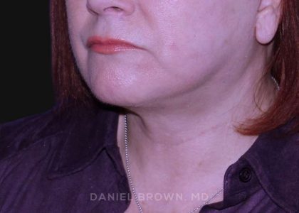Neck Restoration Before & After Patient #10520
