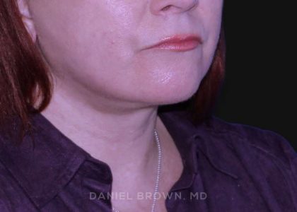 Neck Restoration Before & After Patient #10520