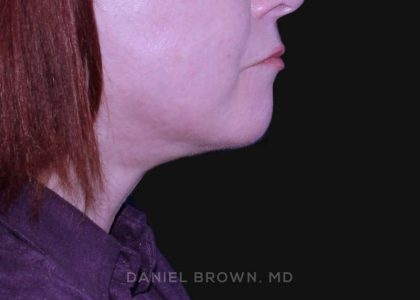 Neck Restoration Before & After Patient #10520
