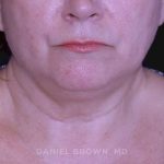 Neck Restoration Before & After Patient #10520
