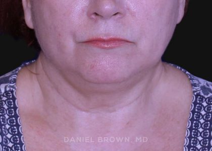 Neck Restoration Before & After Patient #10520