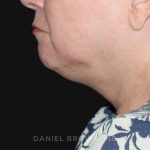 Neck Restoration Before & After Patient #10520