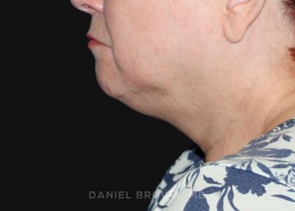 Neck Restoration Before & After Patient #10520