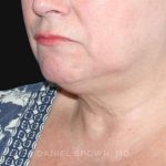 Neck Restoration Before & After Patient #10520