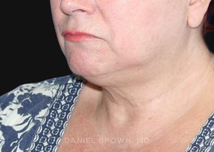 Neck Restoration Before & After Patient #10520
