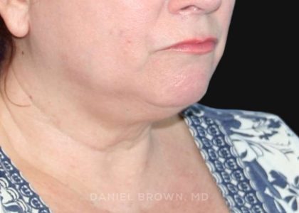 Neck Restoration Before & After Patient #10520