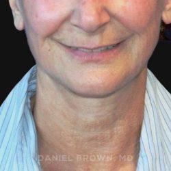 Neck Restoration Before & After Patient #10531