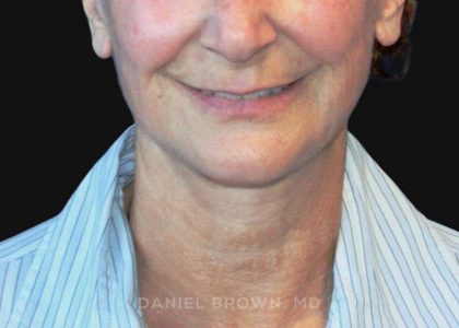 Neck Restoration Before & After Patient #10531