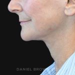 Neck Restoration Before & After Patient #10531