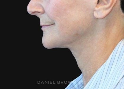 Neck Restoration Before & After Patient #10531