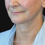 Neck Restoration Before & After Patient #10531